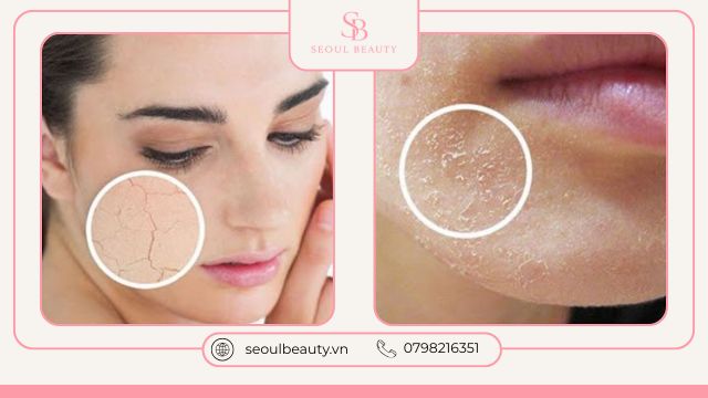 Tác hại khi da dầu mụn không dưỡng ẩm